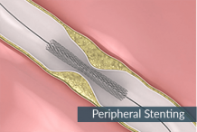 Peripheral Stenting Hyderabad - Peripheral Vascular Treatment Telangana, AP