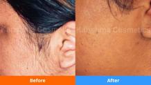 laser hair removal in Pune | Karishma Cosmetic | Hair removal