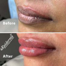 #1 Best Permanent Lip Blushing in Durgapur