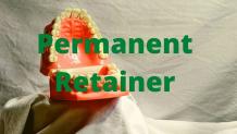 Permanent Retainer Meaning, Cost, Broke, Removal, Problems