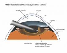 Cataract Surgery Pune, India | Cataract Treatment - Dada Laser Eye Institute