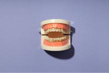Rotting and Breaking Teeth? You&#039;re Not Alone