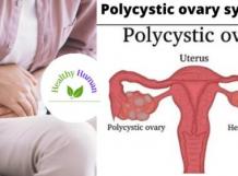 Facts About Polycystic Ovary Syndrome-healthylifehuman