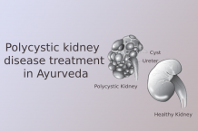 Polycystic Kidney Disease Symptoms and Causes  - Polycystic Kidney Disease Treatment in Ayurveda