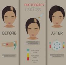 Cost of PRP Treatment for Hair Loss Delhi, PRP Face Treatment in Delhi