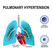 Pulmonary Artery Hypertension - DrCRaghu