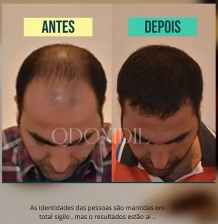 Qdoxidil Funciona? Calvície, Bula, Antes e Depois (Saiba Tudo!)