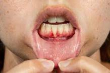 How You Can Cure Swollen Gums at Home?