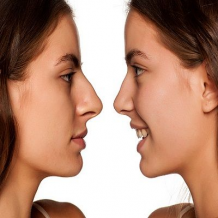 Rhinoplasty - It&#39;s About Your Nose Reshaping