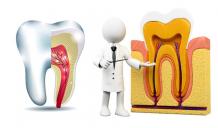 Root Canal Treatment in Mumbai - Cost of root canal Smile Store