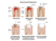 Concerned about infected tooth? | Root Canal Treatment and Costing in Pune