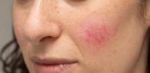 A Complete Guide To Rosacea | brayancarrol