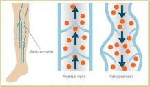 varicose veins