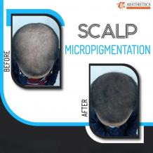 SMP (Scalp micropigmentation) - Dr Waris Anwar Aesthetics