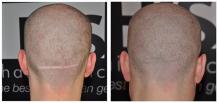 Hair Transplant Scar Removal Procedure | Hair Transplant Dubai