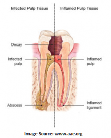 How Can Root Canal Treatment Help You? | Dental Sphere, FC Road, Pune