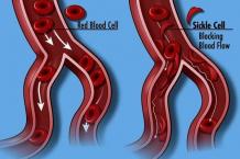 Best Sickle Cell Doctor – Sickle Cell Anemia Treatment in India