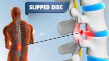 slipped disc