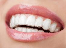 A Beginner's Guide to invisalign manchester review