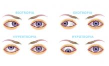 Squint Eye Surgery - Dr. Anisha Gupta - Excel Eye 
