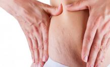 Best Stretch Marks Treatment Clinic, Cost in Delhi, Rajouri Garden, West Delhi, India