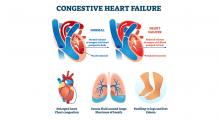 Diagnosing Congestive Heart Failure