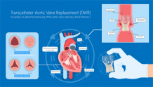 Transcatheter Aortic Valve Replacement and Implantation | TAVR and TAVI Expert in India Dr. Raghu 