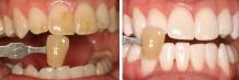 Teeth Whitening Services Houston | Teeth Bleaching Services Near Me