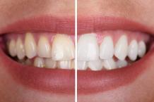 Professional Teeth Whitening in Fort Worth | Prestige Dental