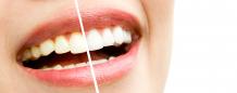 Best Teeth Whitening Treatment in Delhi | Coral Dental