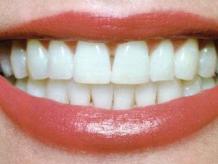 Teeth Whitening In Pune | Dental Clinic In Mukundnagar and FC Road