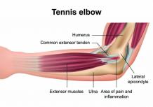 tennis elbow treatment