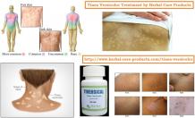 10 Natural Remedies for Tinea Versicolor - Herbal Care Products