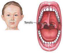 how to get rid of tonsils in children