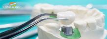 Tooth Implants Are Now Simpler and Affordable with Cosmodent India