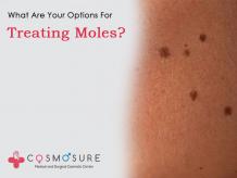 Mole Removal Treatment In Hyderabad | Cosmosure Clinic