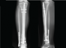 Uso del enclavamiento intramedular en el tratamiento de fracturas