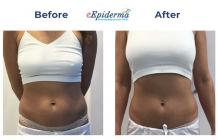 #1 Best Belly/Tummy Fat Reduction Treatment In Durgapur