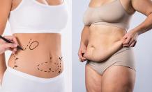 Tummy Tuck or Liposuction – Which One Do I Need?