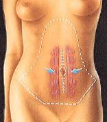 Tummy Tuck Surgery, Abdominoplasty Packages in Thailand &amp; Malaysia