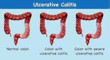 Ulcerative colitis - Causes, Symptoms, Diagnosis and Ayurvedic Treatment