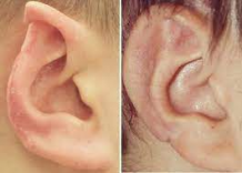 Cosmetic Ear Surgery Pin Back Your Ears - WriteUpCafe.com