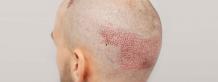 Can Grafts Fall Out After Hair Transplant? | Hair Transplant Dubai