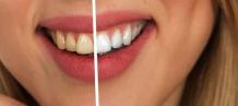 Everything You Need to Know About Your First-Ever Teeth Whitening Treatment