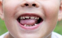 Orthodontic Solutions For Kids With Protruding Teeth