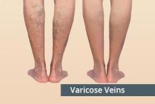 Varicose Veins Treatment in Hyderabad, Telangana | Dr. Abhilash