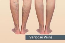 Varicose veins treatment in hyderabad | Dr. Abhilash