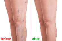 Best Varicose Veins Laser Treatment in Hyderabad | Dr. Abhilash