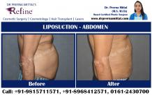 Finding Liposuction surgeon in ludhiana