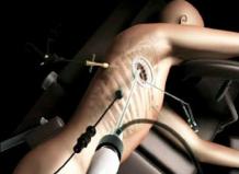 Video Assisted Thoracic Surgery or VATS Surgery in Gurgaon 